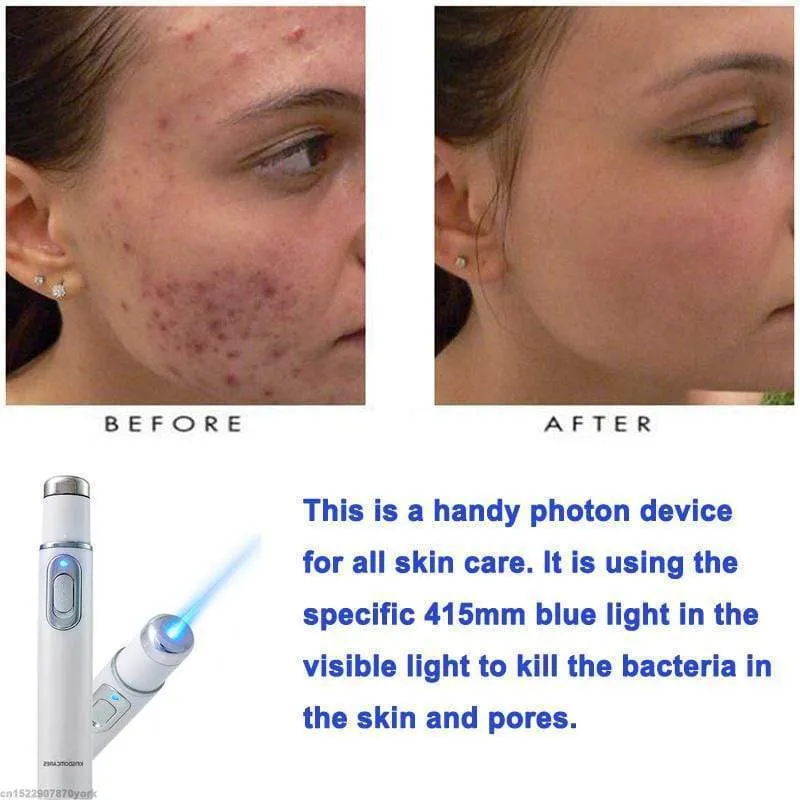 Face Acne Laser Pen